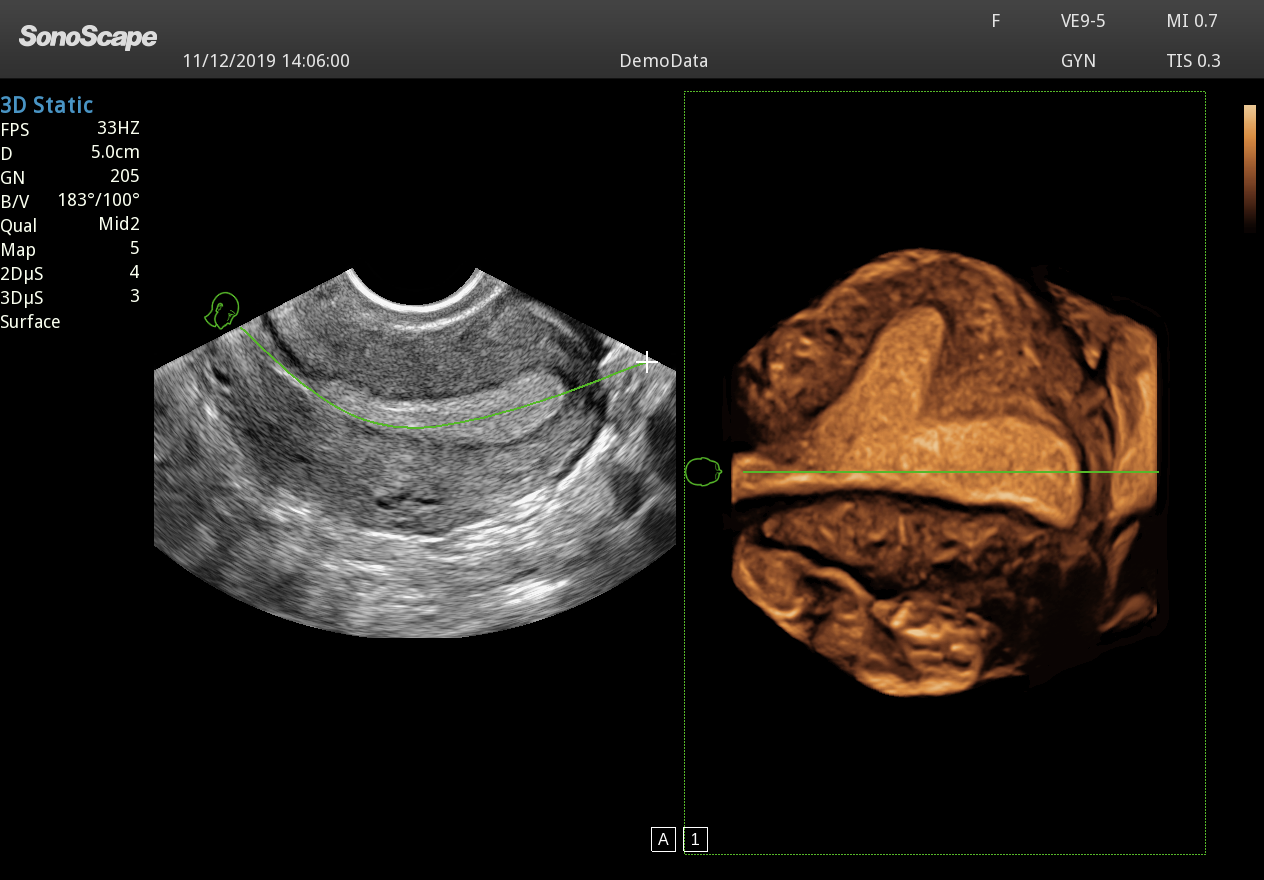 Echographe pour Gynécologue - Gynécologie Obstétrique. Echographie 3D de l'utérus et de l'endomètre