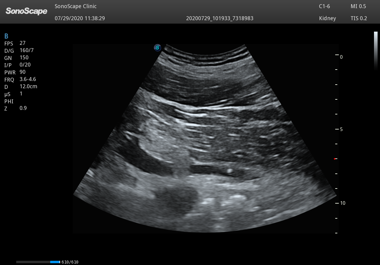 échographe pour urologue - Echographie de l'urètre et présence de calcul