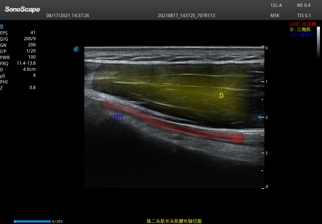 Echographe Premium Musculosquelettique SonoScape P40 Elite
