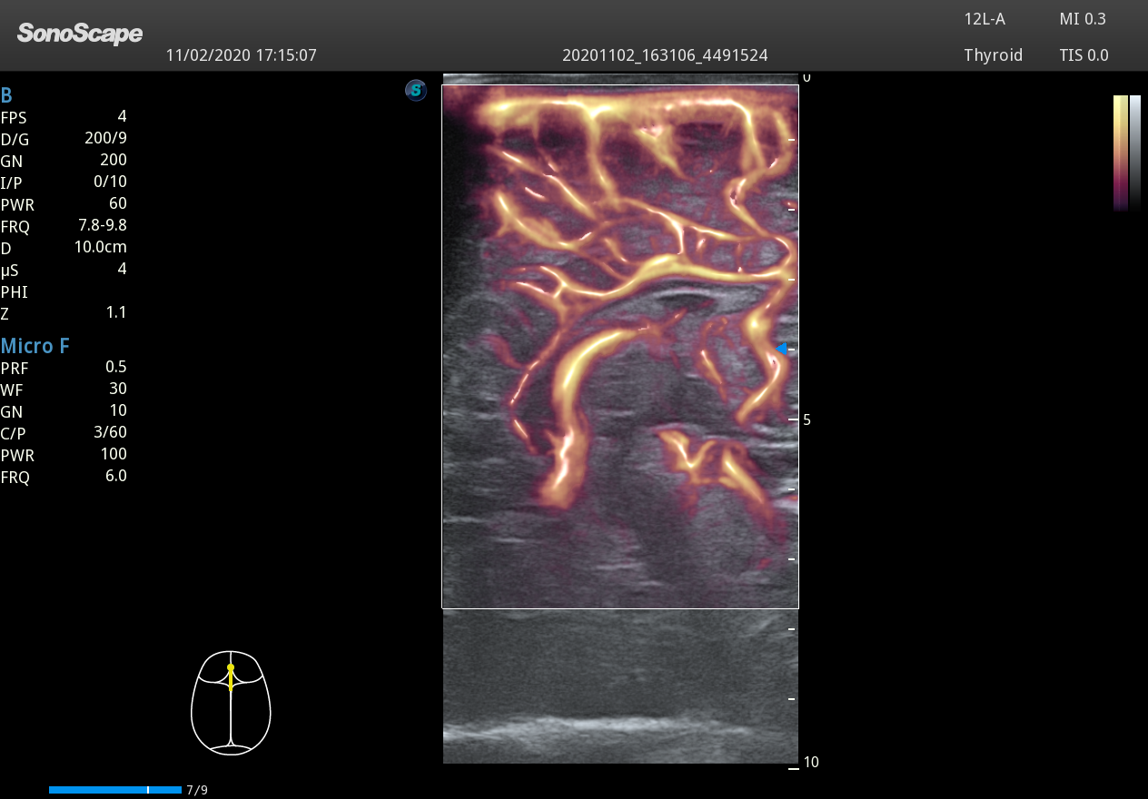 Echographe Haut de Gamme Radiologie - Bright Flow SonoScape P40 Elite