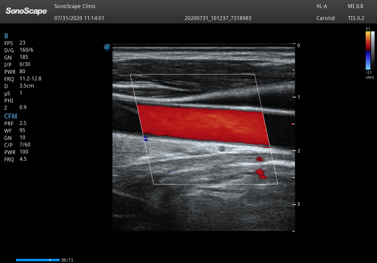 Echographe Couleur Vasculaire- SonoScape P15