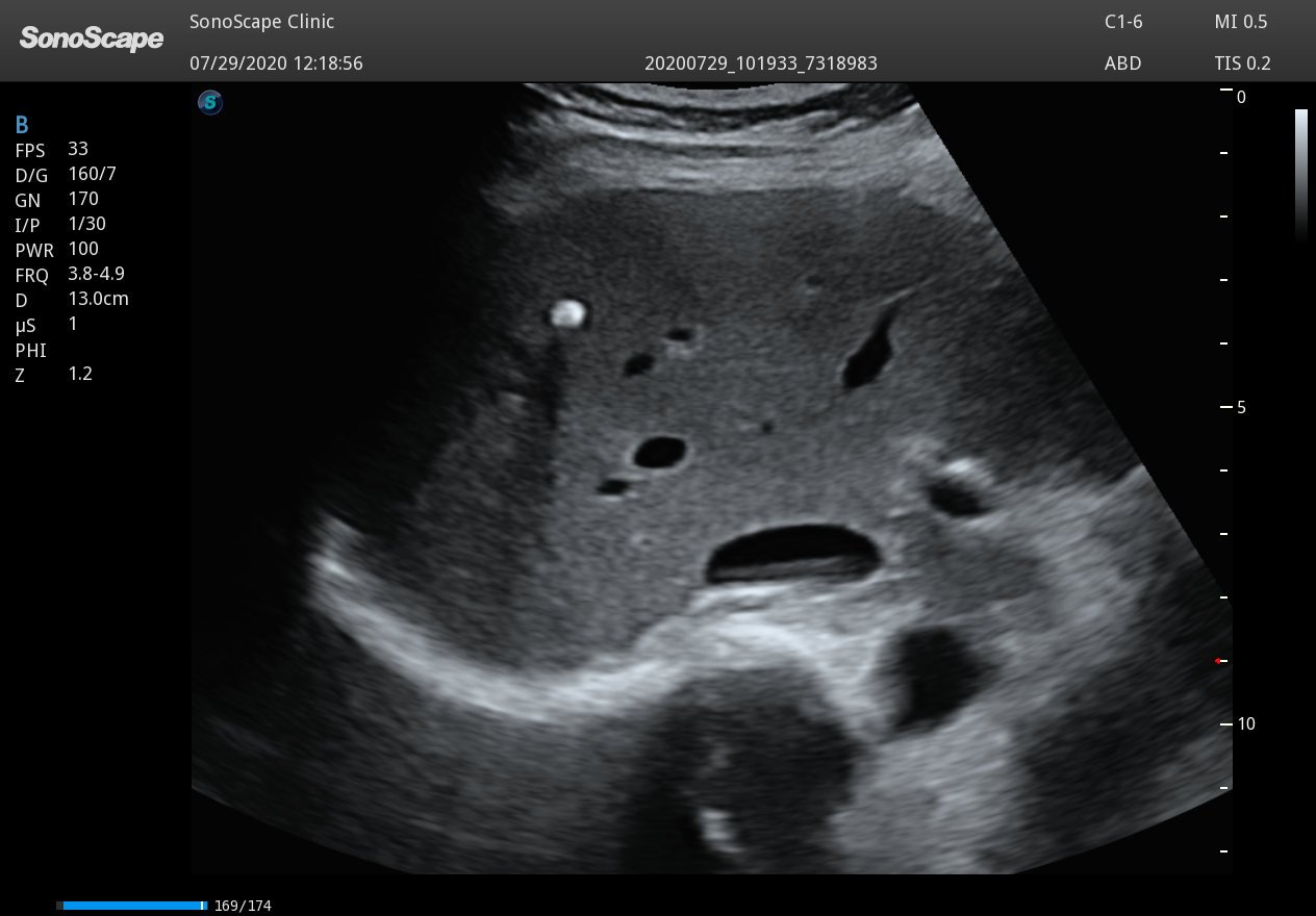 Echographe Couleur Gastroentérologie- SonoScape P15