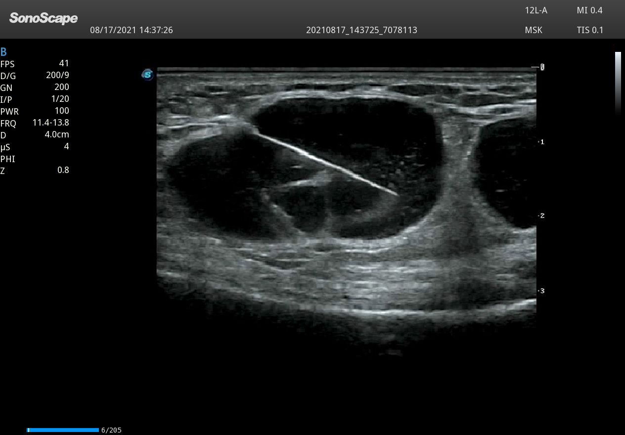 Echographe pour bloc opératoire - Module Echoguidage